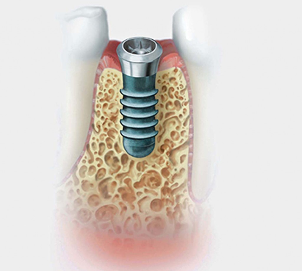 Diş İmplantı