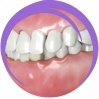 Dental Malocclusions