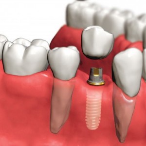 placing implant