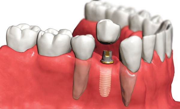 placing implant