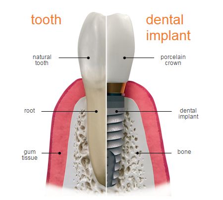 Dental implant