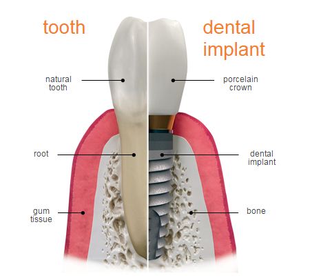 implantbolumleri