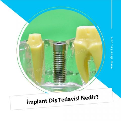 İmplant Diş Tedavisi Nedir?