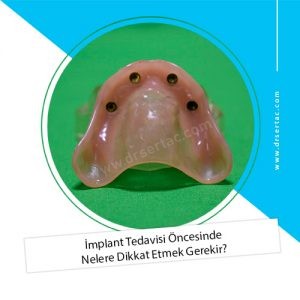 İmplant Tedavisi Öncesinde Nelere Dikkat Etmek Gerekir?