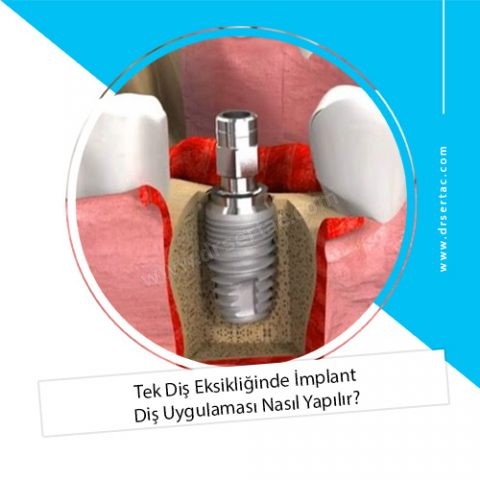 Tek Diş Eksikliğinde İmplant Diş Uygulaması Nasıl Yapılır?